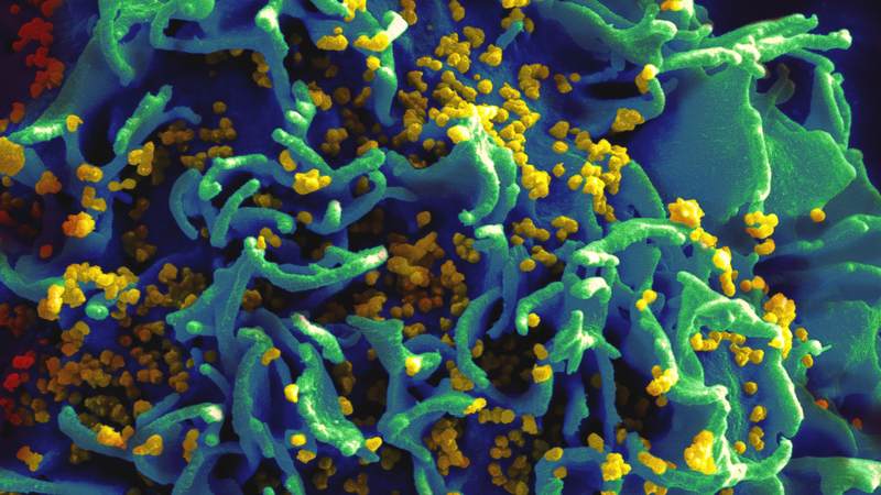 An electron micrograph of HIV particles infecting a human T cell. Image: National Institute of Allergy and Infectious Diseases
